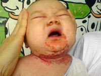 Viêm da cơ địa và thuốc chữa Viêm da cơ địa và thuốc chữa