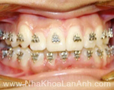 Ai thắc mắc về niềng răng thí zo nha