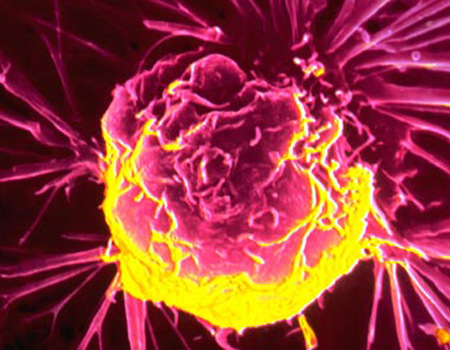 Một tế bào ung thư được nhìn thấy dưới kính hiển vi. Ảnh: NCI.