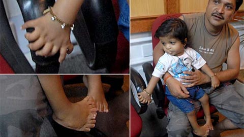 Bé trai Akshat có tổng cộng 34 ngón tay và ngón chân. Ảnh: Supplied