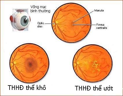 Cách nào giảm rủi ro mắc thoái hóa điểm vàng?