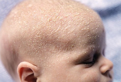 Bí quyết bảo vệ các vấn đề về da cho trẻ sơ sinh mùa lạnh 
