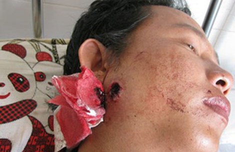 Huỳnh Nhật Quang và vết thương do bị ông Dũng bắn. Ảnh: T.VŨ