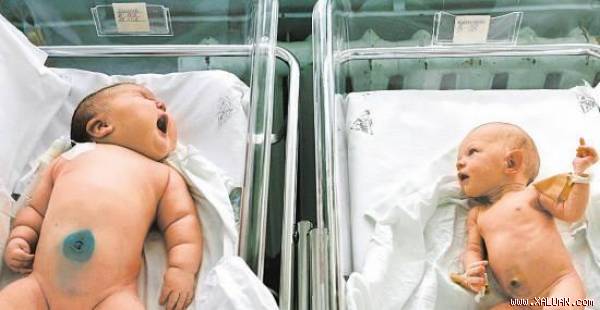 Em bé sơ sinh nặng 18 kg (bên trái) và em bé bình thường (bên phải).