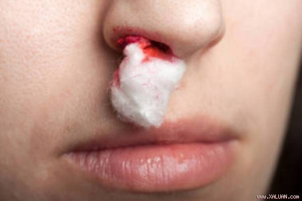 Chảy máu cam có thể do dị ứng, viêm mũi hoặc không khí quá khô
