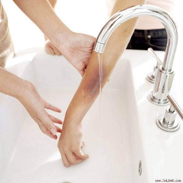 Cách chữa bỏng nước sôi hữu hiệu nhất là ngâm chỗ bỏng vào nước hoặc để dưới vòi nước chảy.