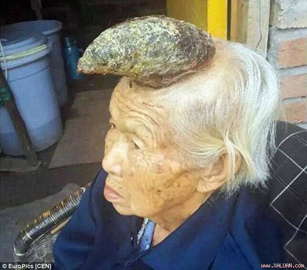 Chiếc sừng dài 13 cm mọc ngay trên đầu bà Xiuzhen.