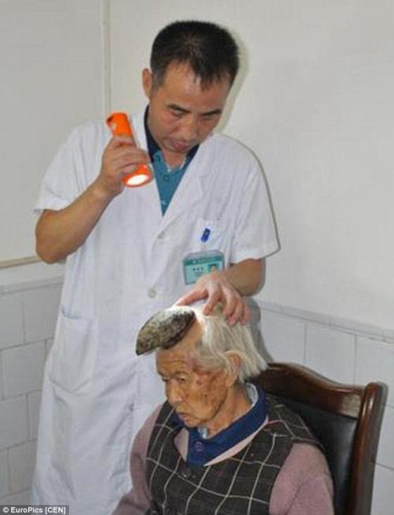 Bác sĩ tiến hành kiểm tra chiếc sừng trên đầu bà Xiuzhen.