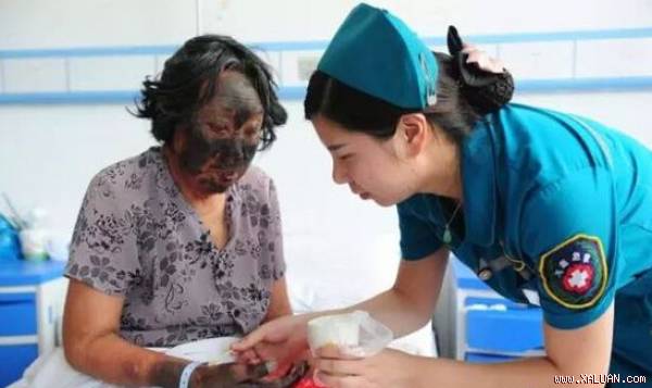 Phần mặt và tay hở ra đều đen như than.