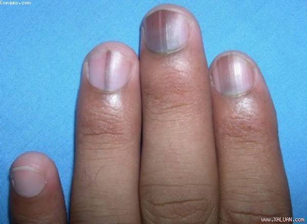 Dấu hiệu ‘khởi phát’ rất dễ nhận biết khi mắc bệnh ung thư