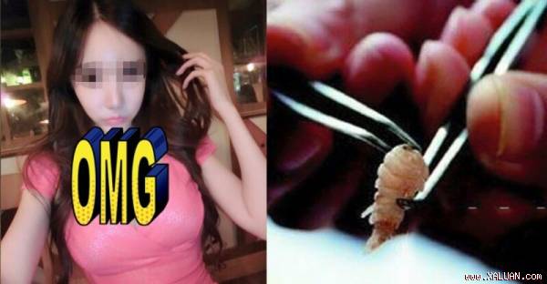 Trong bụng cô gái trẻ có hơn 10 con côn trùng bác sĩ giật mình khi biết nguyên nhân