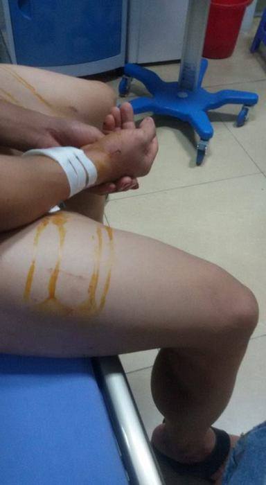 Một trong số 4 nạn nhân bị thương nặng đang được điều trị tại bệnh viện. (Ảnh Hồ Khoa) Một trong số 4 nạn nhân bị thương nặng đang được điều trị tại bệnh viện. (Ảnh Hồ Khoa)
