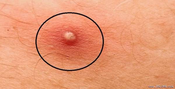 Chẳng còn lo đau, ngại sẹo khi trị mụn nhọt theo cách sau