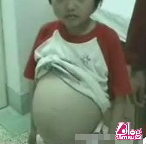 Bé gái đáng thương đã bị mọc một khối u trong bụng Bé gái đáng thương đã bị mọc một khối u trong bụng