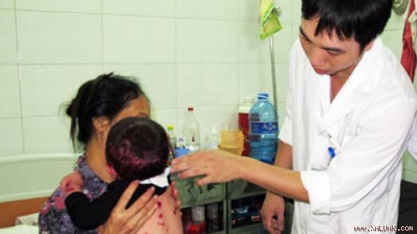  Một trường hợp bệnh nhi bị mắc bệnh thủy đậu.