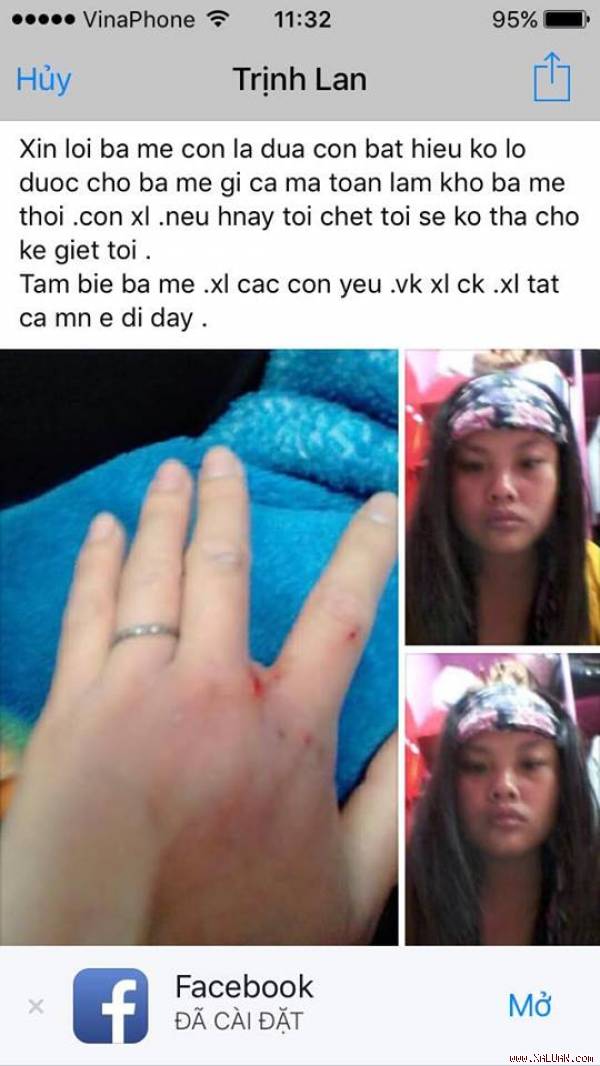 Lao động Ngà bị chủ nhà&nbsp;đánh thâm tím tay, mặt (Ảnh nhân vật)