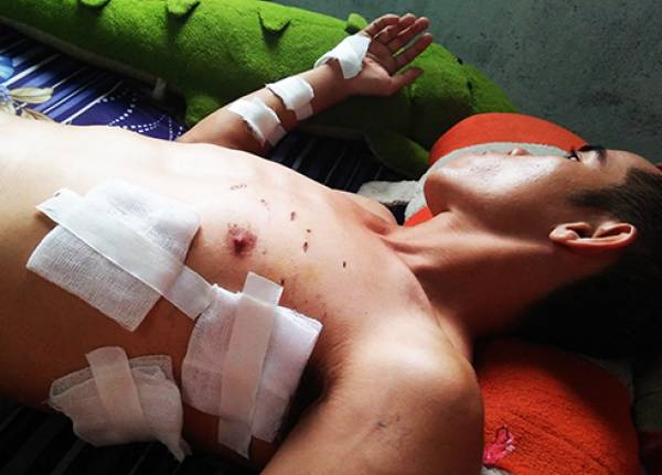 Những vết thương do đạn bắn trên người anh Hiệp