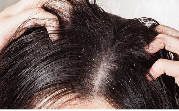 Nên thường xuyên kiểm tra đầu trẻ để sớm phát hiện chấy. Ảnh: T.L
