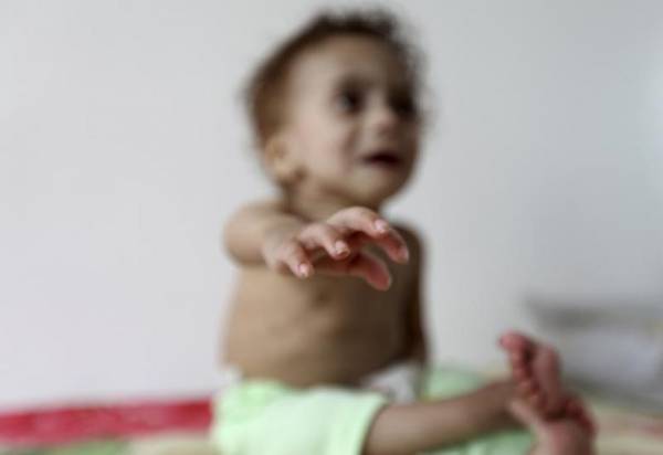 Trẻ Yemen còn da bọc xương vì nạn đói thảm khốc