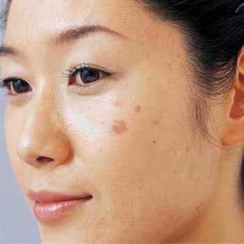 Kết quả hình ảnh cho gò má có tà n nhang