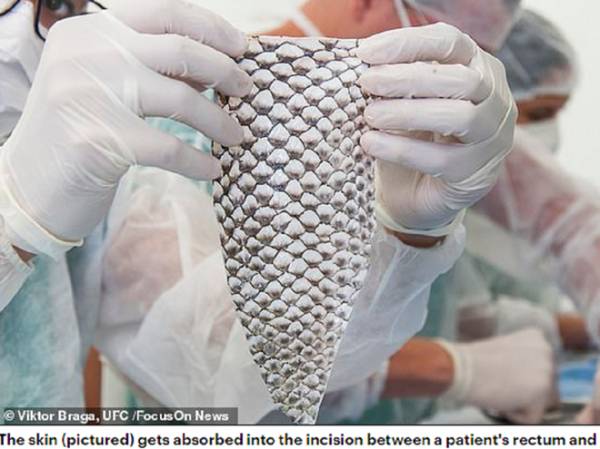 Maju đã trở thành người chuyển giới đầu tiên trên thế giới được tài tạo âm đạo bằng da cá rô phi