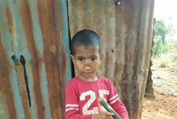Bé Rơ Chăm Khang trước khi phẫu thuật bên căn nhà của mình. Ảnh: Sức Khỏe Đời Sống.
