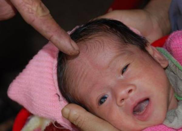 Mở khóa đầu ở trẻ sơ sinh là bệnh gì?