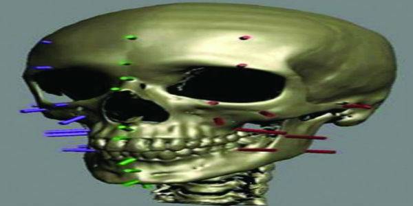 Các chốt được cắm lên hộp sọ để đánh dấu độ sâu mô mềm.