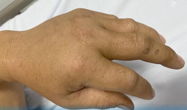 Truyền 18 lọ huyết thanh cứu bệnh nhân bị rắn lục đuôi đỏ cắn